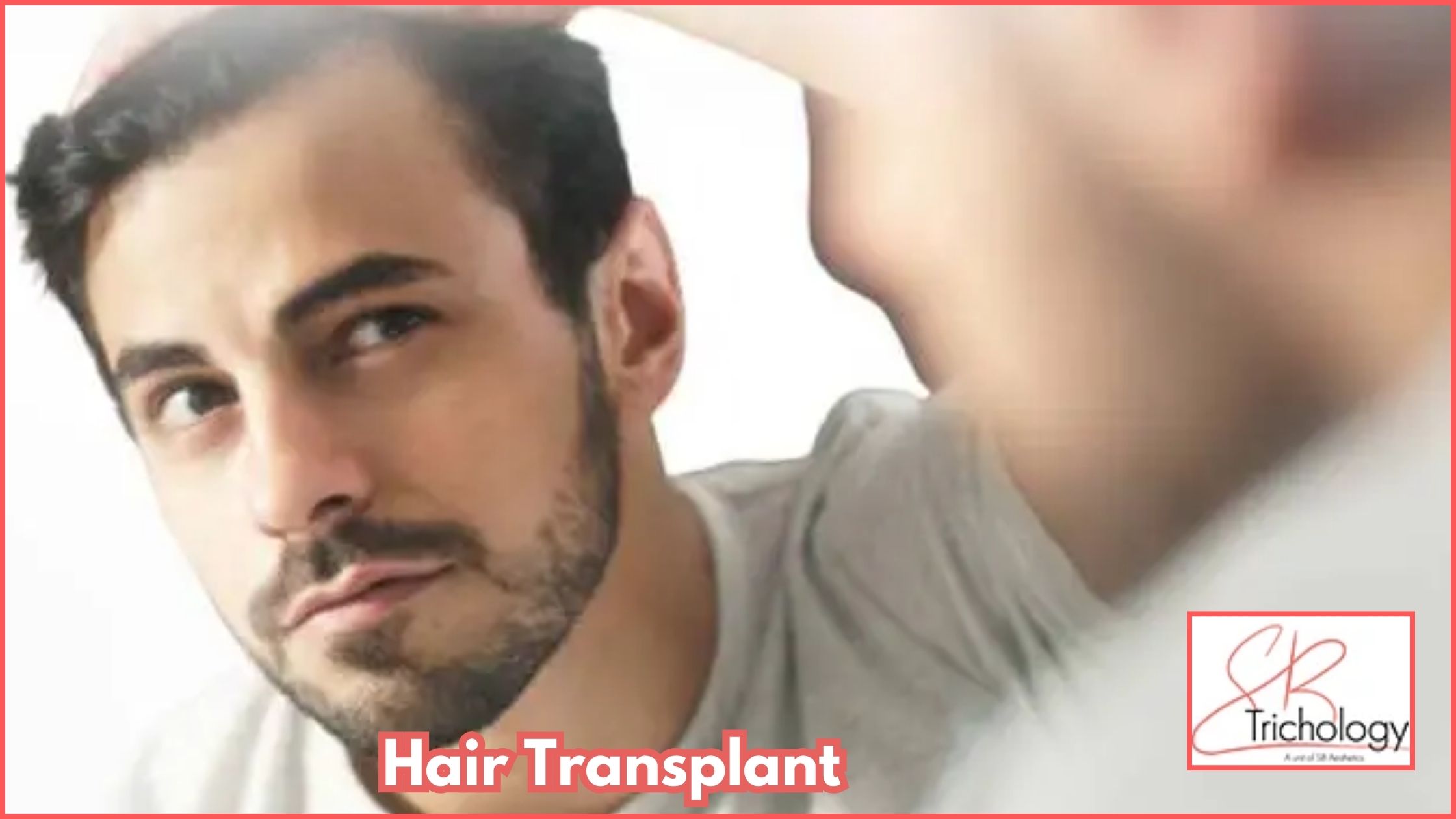 Hair Transplant In Gurgaon At Sb Trichology